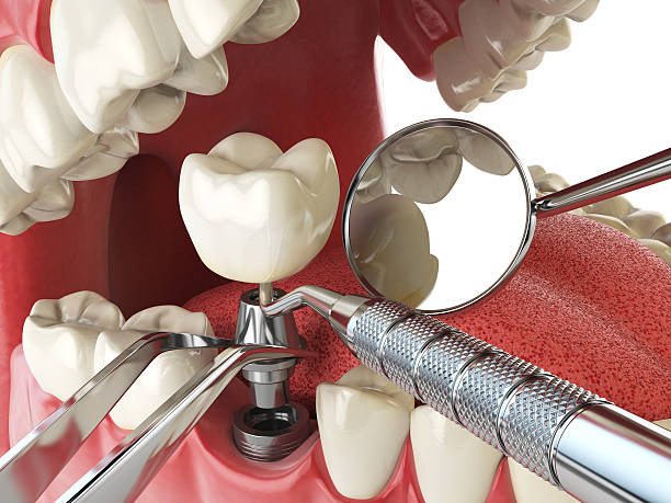 Best Emergency Dentist for Lost Fillings or Crowns in Rutledge, GA